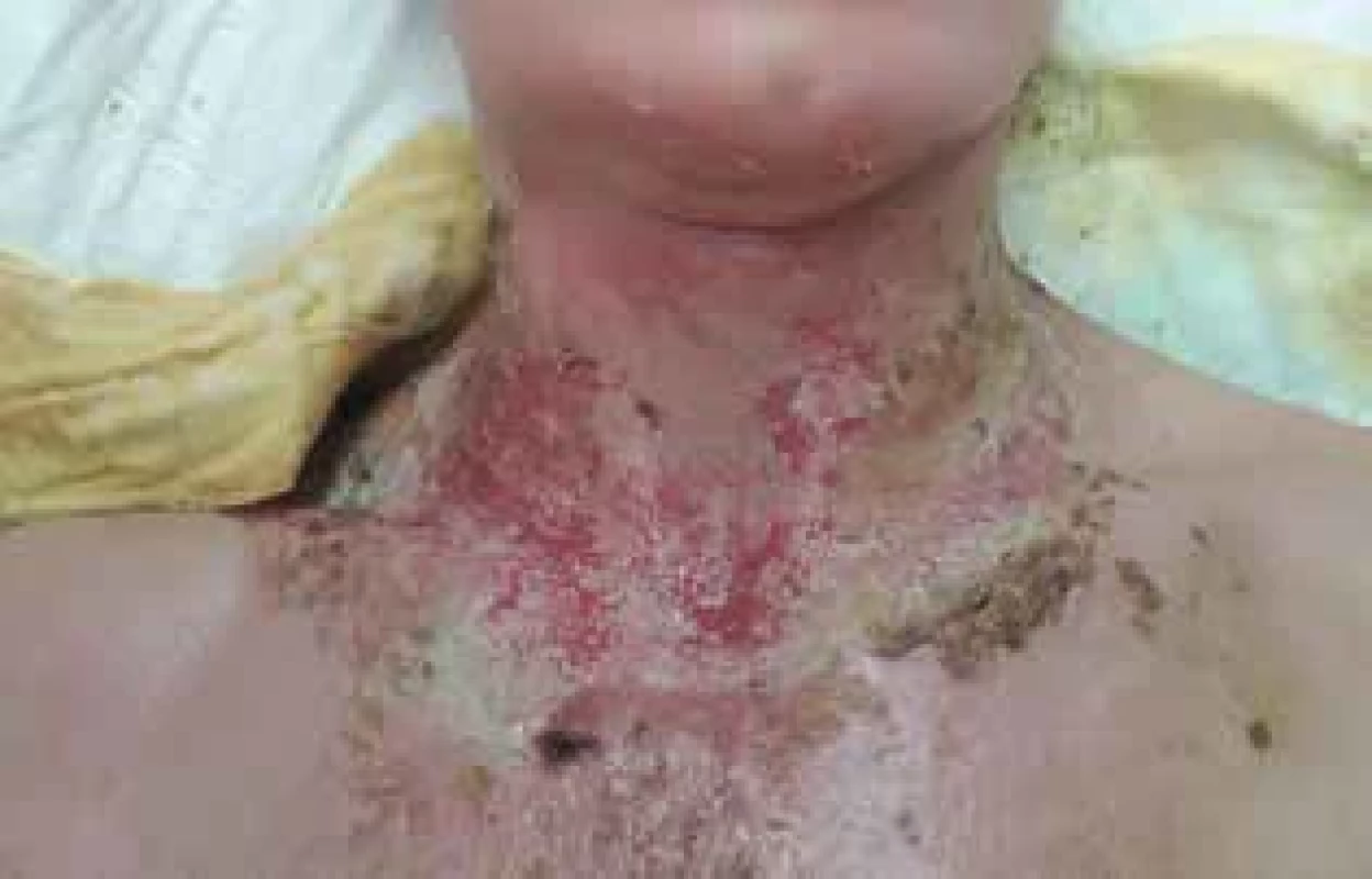 Eczema herpeticatum – hojení