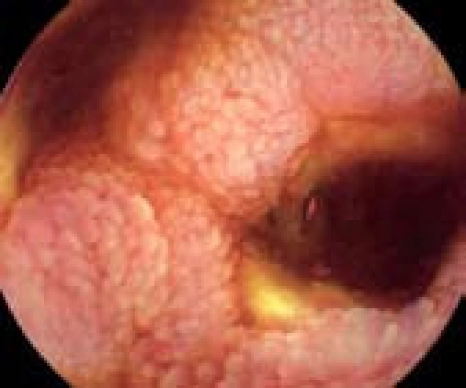 Stenóza anastomózy po resekci ilea s ulcerací.
Fig. 4. Stenosis of the anastomosis after ileal resection with ulcera.