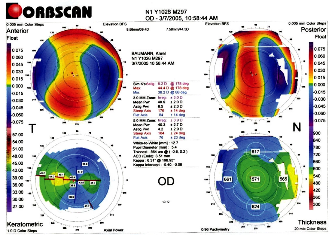 Topografický nález před LASIK (VOD: 4/50,s-5,0 D,-6,0 ax 75………5/7,5,dkn).
