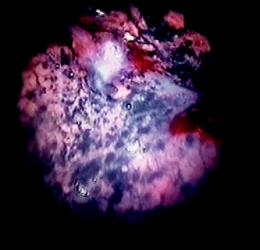 Ložisko adenokarcinómu na viscerálnej pleure v bielom svetle
Fig. 7. A visceral pleura adenocarcinoma focus in white light