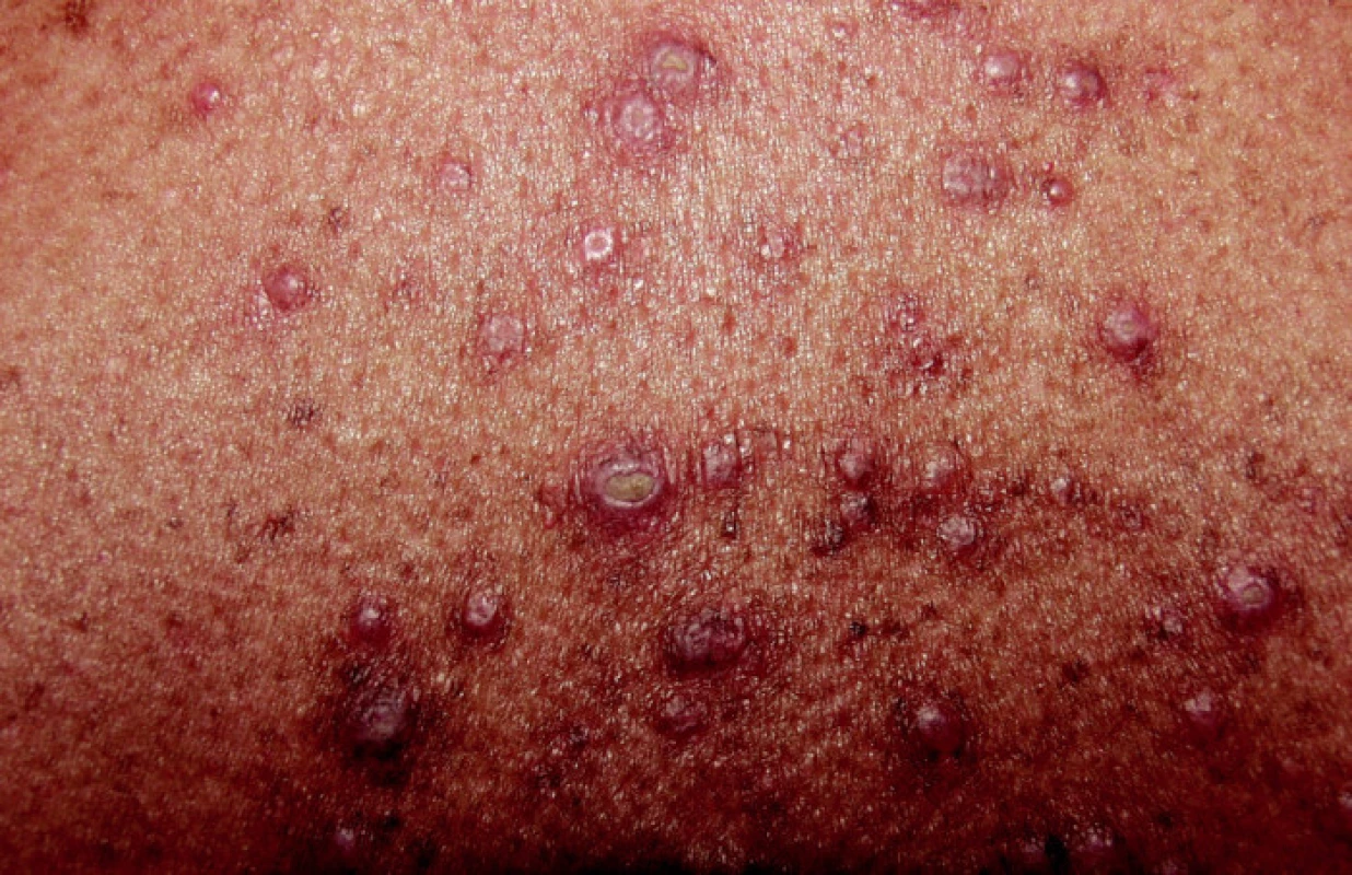 Perforující dermatóza.