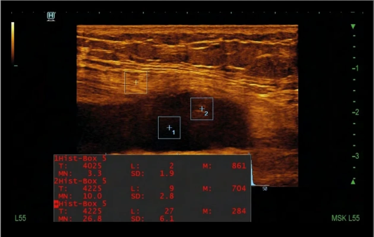 Vzorový echografický synovialogram stadium quartum. Obraz sonografického vyšetrenia recessus suprapatellaris pri prítomnosti exsudátu – softwarové meranie echogenity – histogram, kvalitatívny echografický synovialogram hodnotený ako anechogenný simplexný synovialogram, štádium delta-δ. Sonda v dlhej osi končatiny – suprapatelárny recessus. Vizualizácia: tekutinová kolekcia zmiešanej echogenity, prefemorálne a suprapatelárne tukové teleso, tendo m. quadriceps. Fig. 5. Sample of an echosynovialgram grade IV. Ultrasound image of the presence of fluid collections – exudate, histogram measurements, and quantitative echosynovialgram – simplex anechogenic grade delta-δ. Long axis view of the suprapatellar recess: collection with heterogeneous echogenicity, shadow of the base of the patella, prefemoral fat pad, suprapatellar fat pad, and quadriceps tendon.