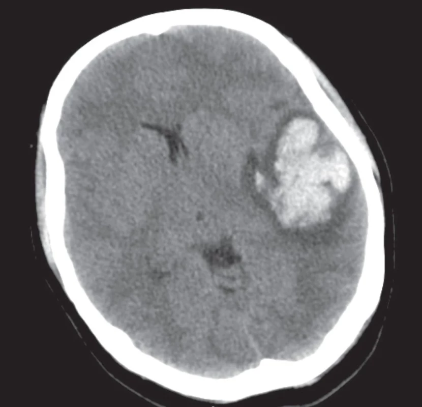 CT mozgu. </br> Fig. 1. CT of the brain.