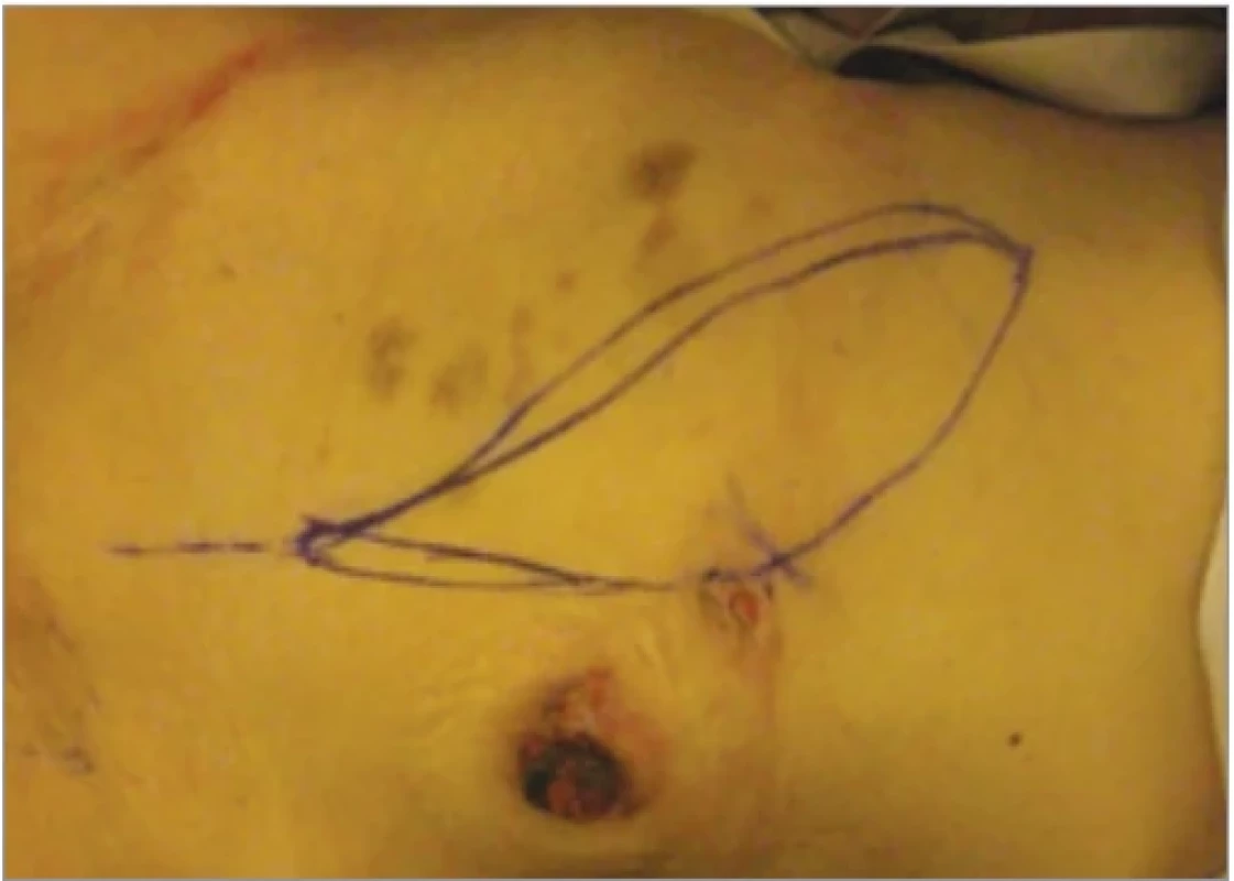 Patient 2 – preoperative skin markings, donor-site.