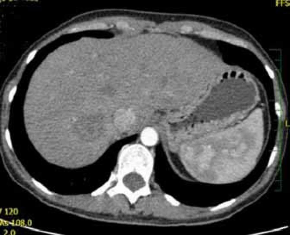 Trojfázové CT jater: arteriální fáze.
Fig. 3. Contrast CT of liver: arterious phase.