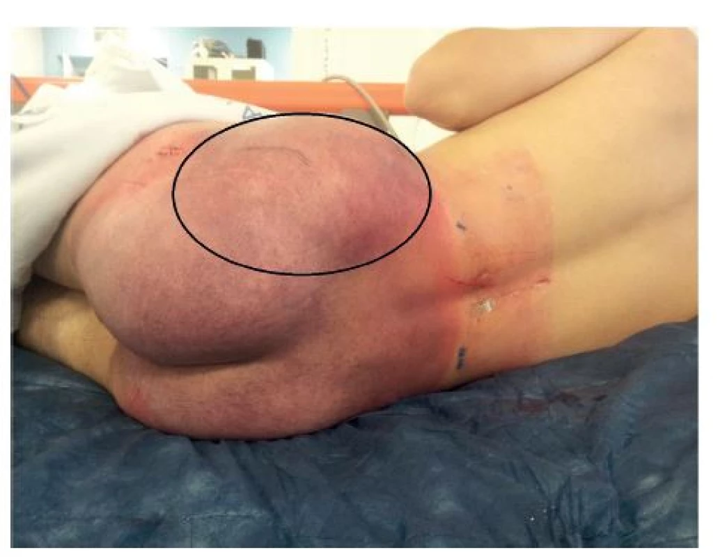 Obr. 2: Rozsáhlá podlitina (“cucflek“) v oblasti hýždě s elastickou rezistencí vlevo
Fig. 2: Large sufusion (“lovebite“) of gluteal area with elastic swelling

