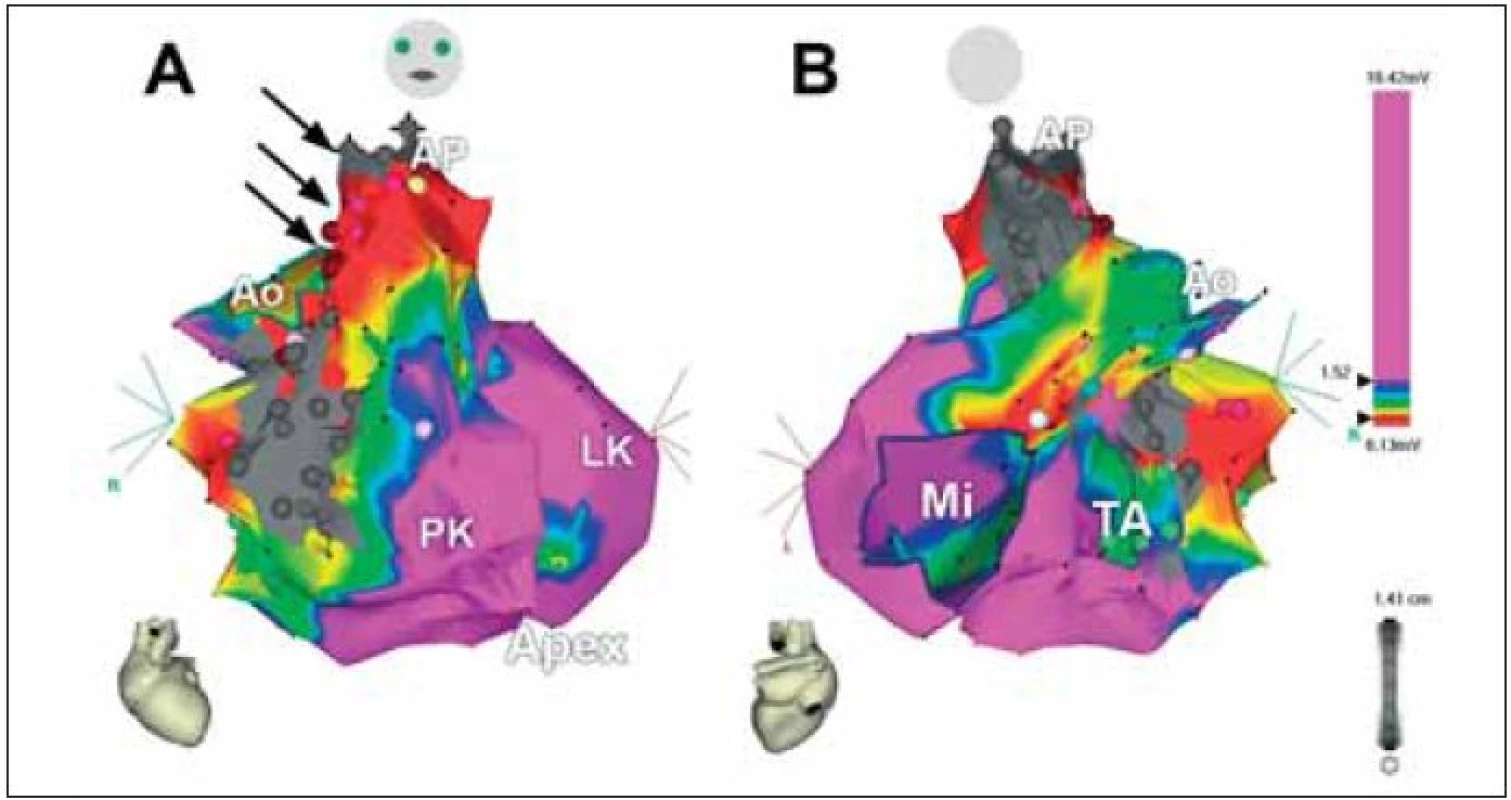 3rozměrná voltážová elektroanatomická mapa obou komor u nemocného s KT po radiální korekci Fallotovy tetralogie. A. Pohled zepředu, B. Pohled zezadu. Šedá barva na volné stěně pravé komory označuje jizvu po ventrikulotomii a rozšíření výtokového traktu pravé komory záplatou, šedá barva, nahoře pod chlopní je vidět šedý okrsek odpovídající záplatě komorového defektu. Šipky označují kanál mezi oběma bariérami, který je uložen v jizevnaté tkáni (červená barva) a který tvořil istmus pro arytmii typu reentry. Katetrizační ablace v tomto kanálu vedla k odstranění indukovatelnosti KT.