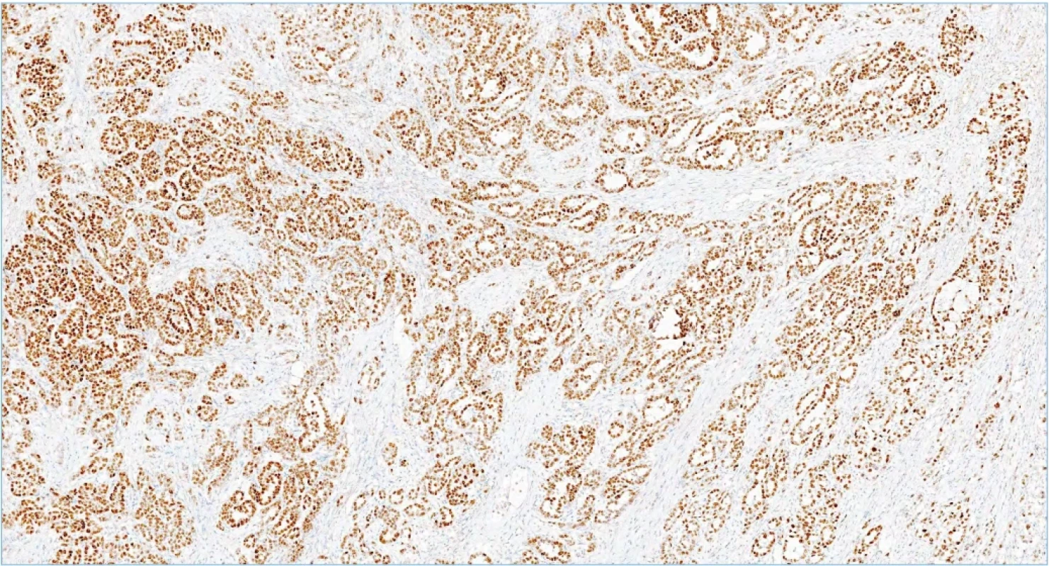 Imunohistochemické vyšetření PAX8, které vykazuje silnou jadernou pozitivitu nádorových buněk. Fig. 1. Immunohistochemical examination PAX8, which shows strong diffuse nuclear positivity in tumor cells. 