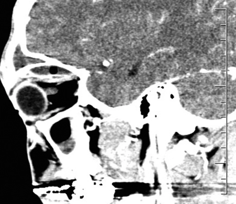 Subperiostálny absces vpravo – sagitálna projekcia.