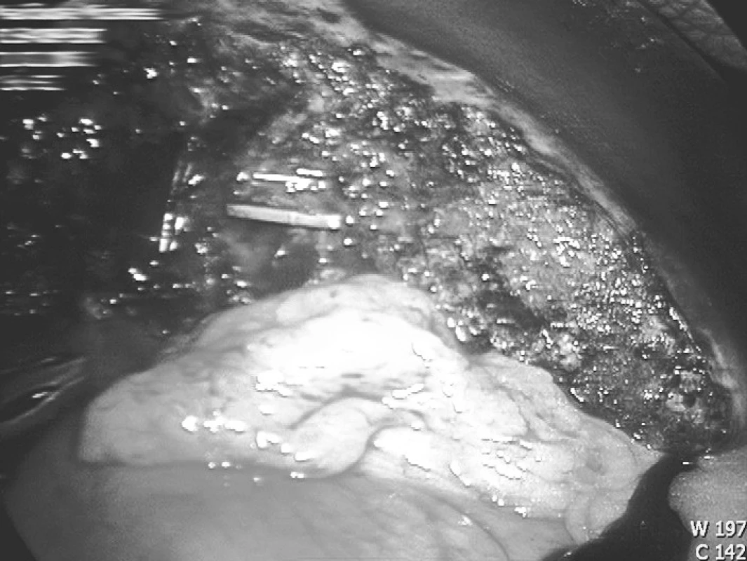 Resekční plocha
Fig. 3. Resection surface