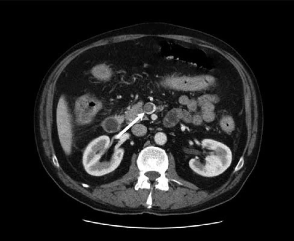 CT vyšetření břicha – portální fáze – částečně obturující trombus vel. 17 mm v kmeni horní mezenterické žíly (bílá šipka).
Fig. 4. Abdominal CT scan – portal phase – partly obstructing 17 mm thrombus in the trunk of the upper mesenteric vein (white arrow).