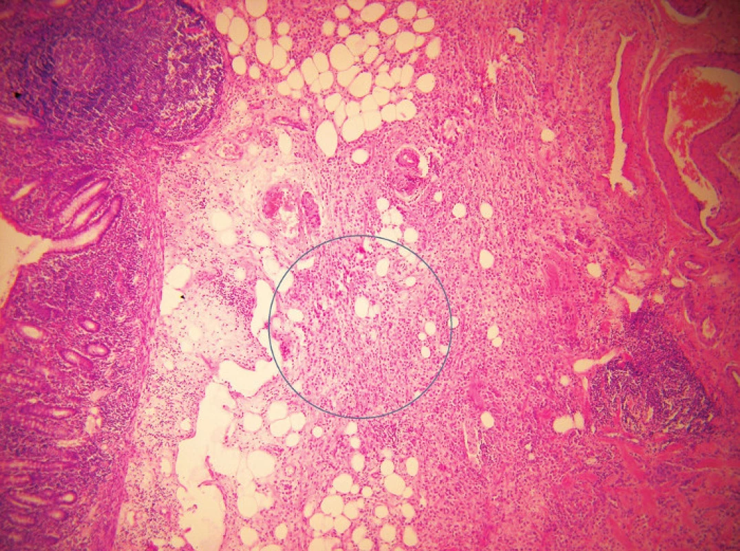 Histologický obraz metastázy ILC (barvení hematoxylin-eozin, zvětšení 100x) V submukóze a muscularis propria tlustého střeva je patrná metastáza klasické varianty ILC s typickým tzv. „single cell files“ uspořádáním (označeno kroužkem) 
Fig. 1: Histological appearance of metastatic ILC (hematoxylin-eosin stain, magnitude 100x). A metastasis of classical type ILC with its typical “single cell files” pattern can be seen in the submucosa and muscularis propria layer of the colonic wall (ringmark)