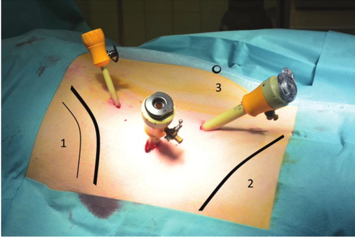 Operačná poloha u LS (1 – costae, 2 – crista iliaca, 3 – umbilicus)
Fig. 1. Surgery position in lumbar sympathectomy (1 – costae, 2 – crista iliaca, 3 – umbilicus)