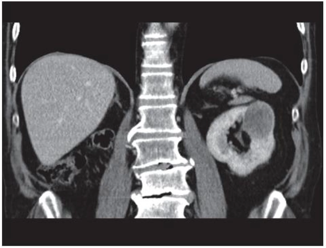 CT vyšetření suspektní expanze levé ledviny
Fig. 1. CT examination-suspicious expansion of the left kidney