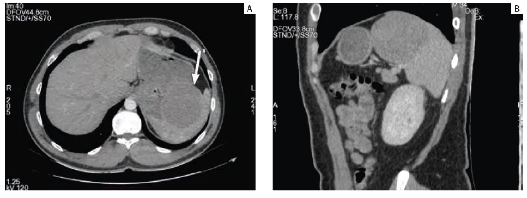 Abdominal CT scan showing a solid, well-circumscribed solitary lesion of the spleen measuring 88 mm in diameter (white arrow). CT vyšetření břicha zobrazující solidní, dobře ohraničenou solitární lézi sleziny o průměru 88 mm (bílá šipka).