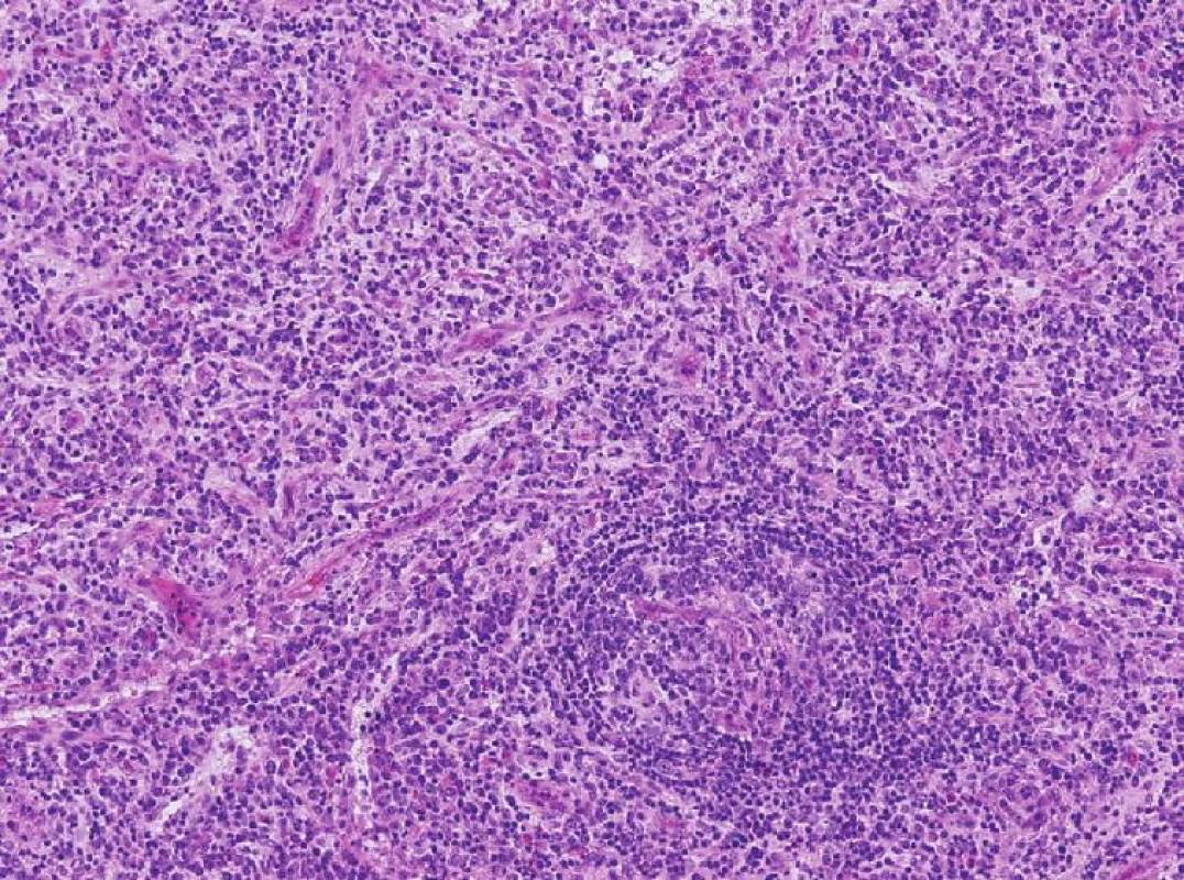 Biopsia LU
Fig. 1. Lymph nodes biopsy