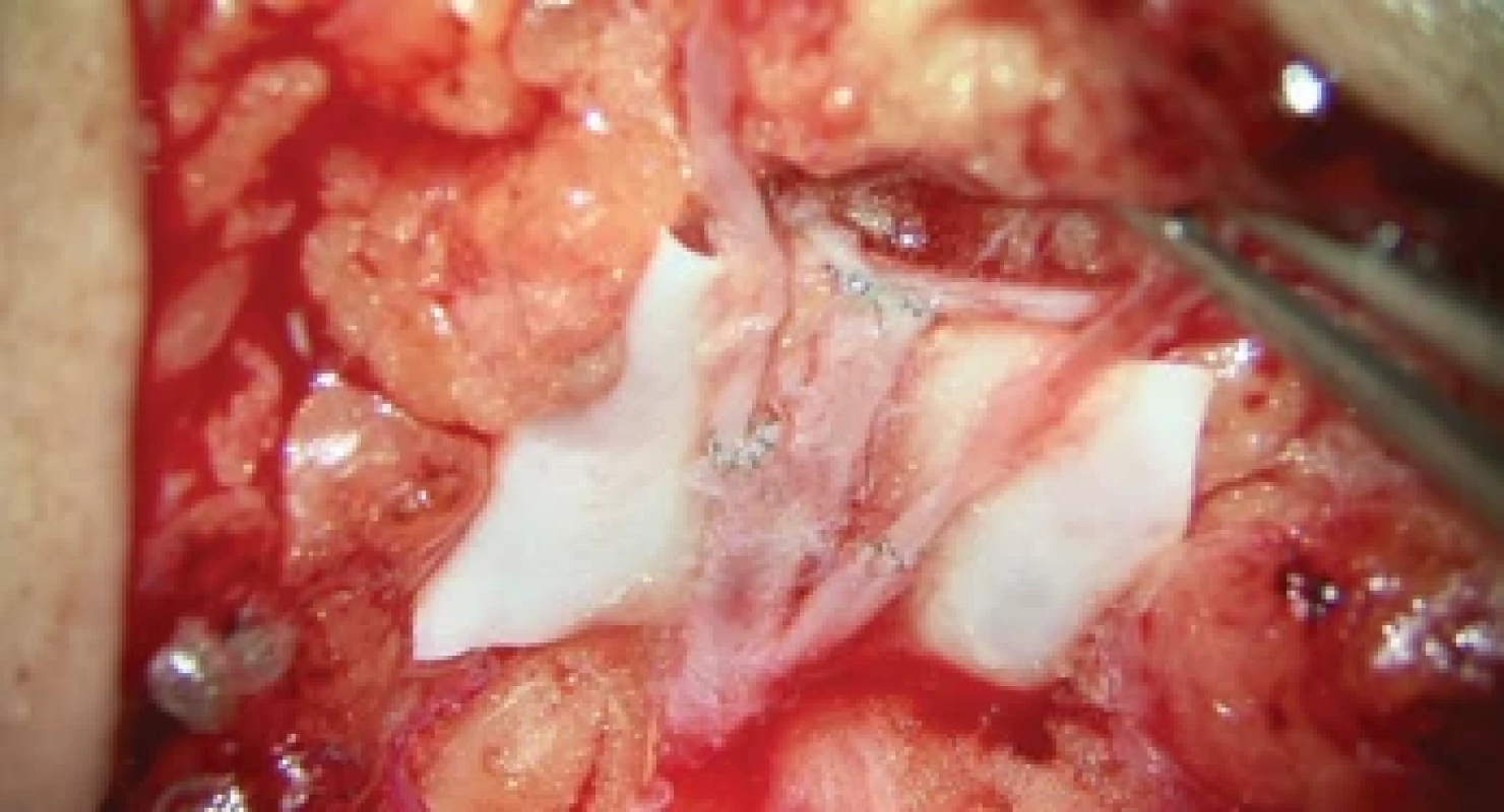 Three LVAs sutured into one vein with three branches, side-to-end anastomoses in the middle.