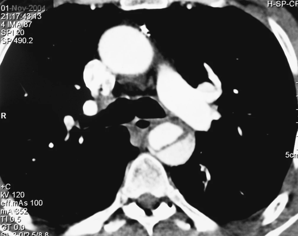 CTA obraz disekce typu B
Pic. 1. A CTA view of the type B dissection
