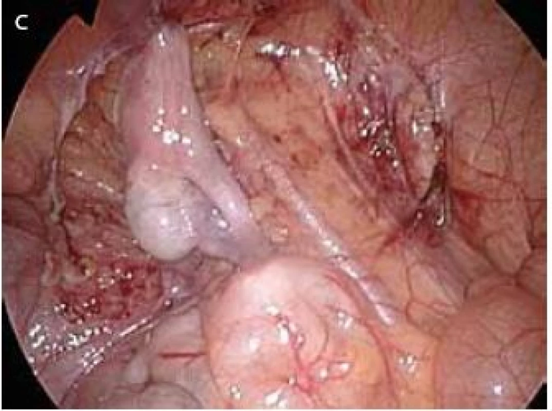 Typy nálezů při diagnostické laparoskopii 
Fig. 2. Findings at diagnostic laparoscopy