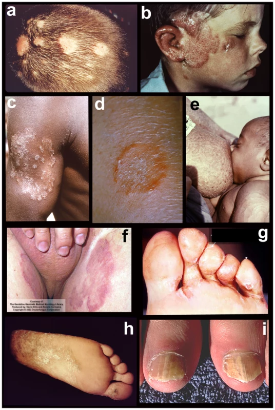 Tineas throughout the body.