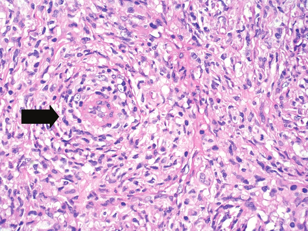 Velké zvětšení umožňující již hodnocení cytologických detailů, nepravidelné kontury jader, eozinofilní cytoplazma. Vlevo od centra zastižena drobná céva (šipka) se silnější stěnou, s perivaskulárním vírovitým růstem nádorových buněk. Hematoxylin-eozin, původní zvětšení 400krát.