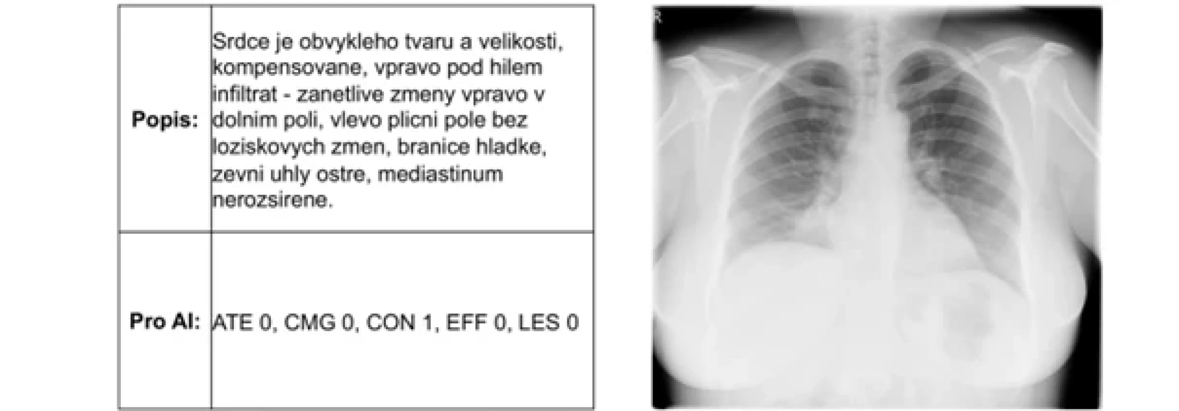 Původní pozitivní rtg snímek hrudníku verifikovaný seniorním radiologem zobrazující zánětlivé změny a odpovídající popis hodnotícího lékaře z Nemocnice Tábor, použitý jako referenční standard pro porovnání s výsledky algoritmu Carebot AI CXR a hodnocením lékařů v multi-reader studii