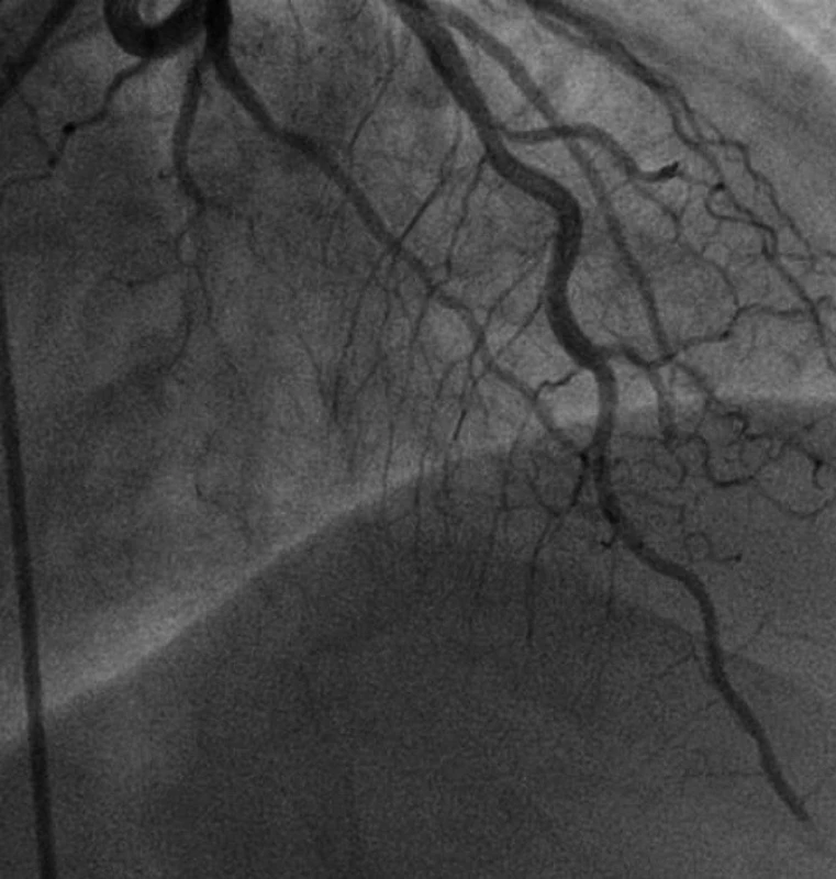 Angiografie: uzávěr distální části ramus interventrikularis anterior
