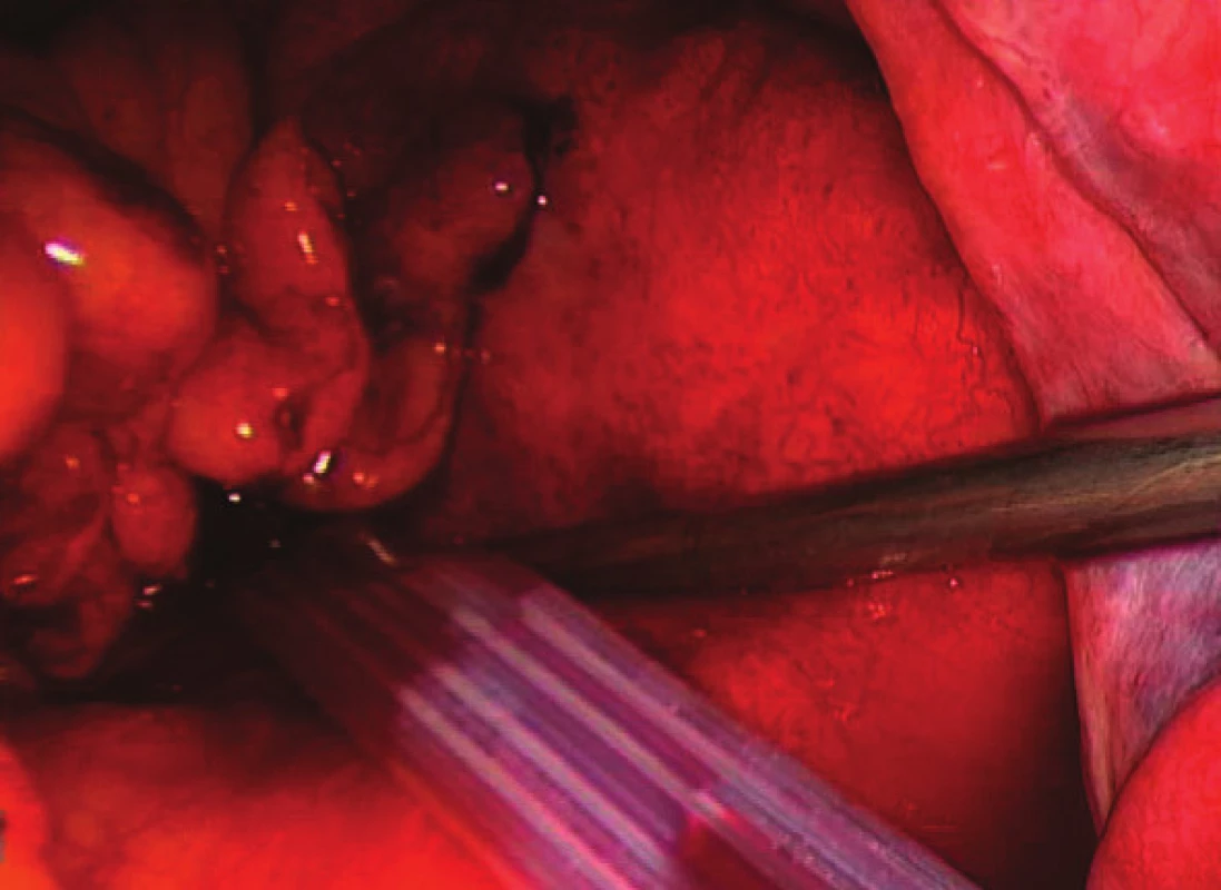 Nález po laparoskopickém ošetření
Fig. 2: The same patient after laparoscopic lavage and drainage