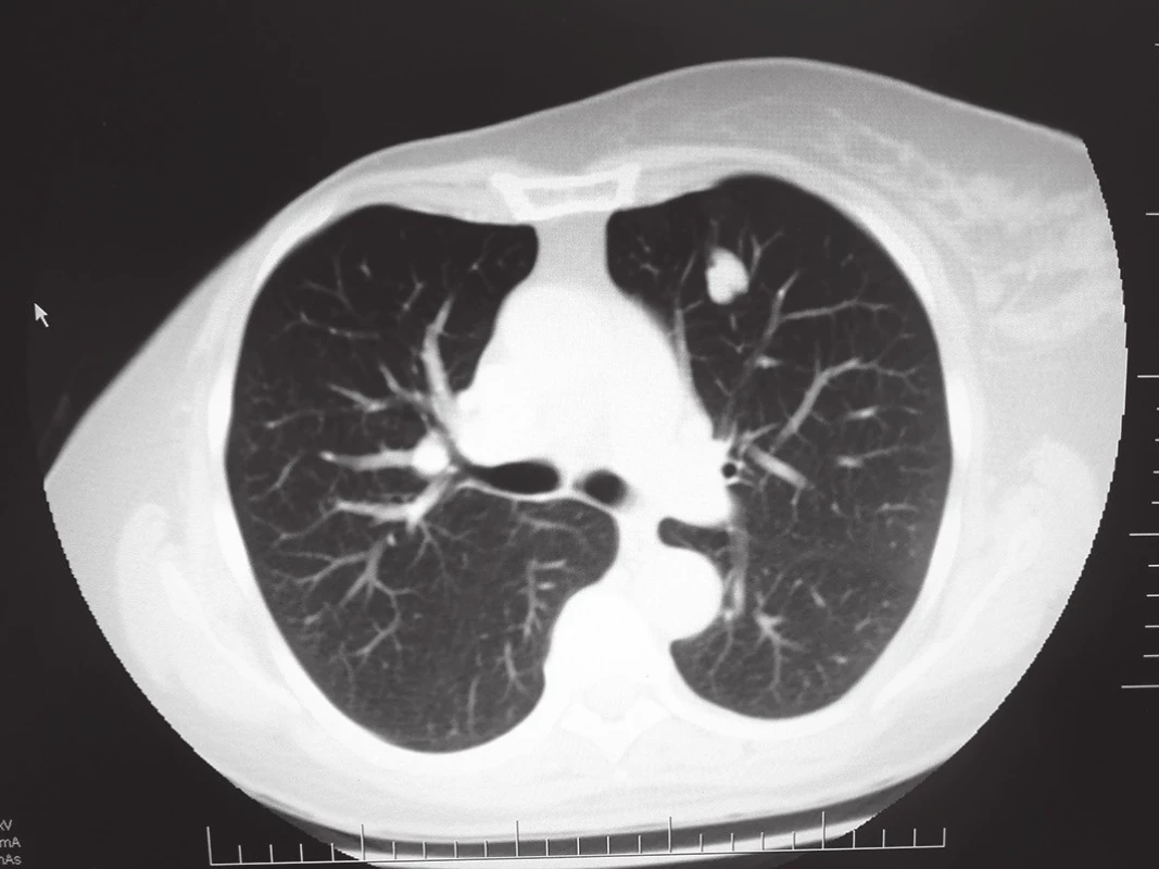 Infiltrace na rozhraní segmentů S4/5 vlevo
Fig. 1: Infiltration of the lung parenchyma between the S4/S5 segments on the left