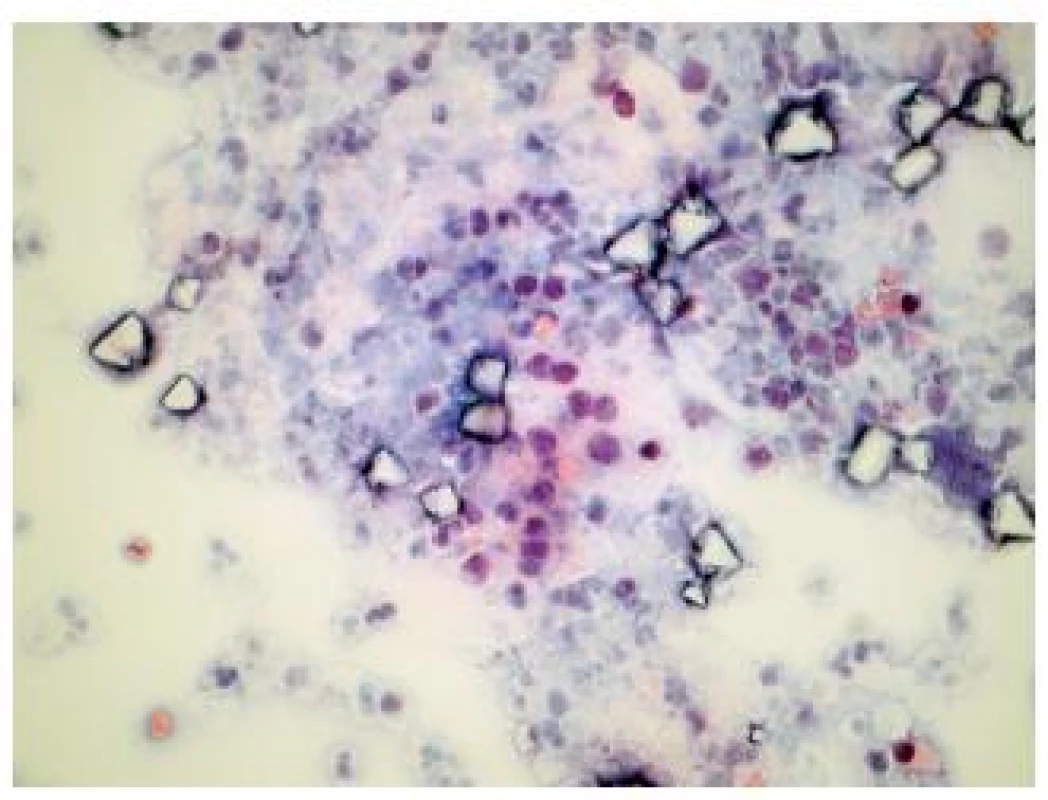 Reaktívne zmenené urotélie u 22 ročného pacienta s mikrohematúriou a negatívnym cystoskopickým nálezom. (Cytospinový preparát, farbenie PAP, zväčšenie 400x.)
