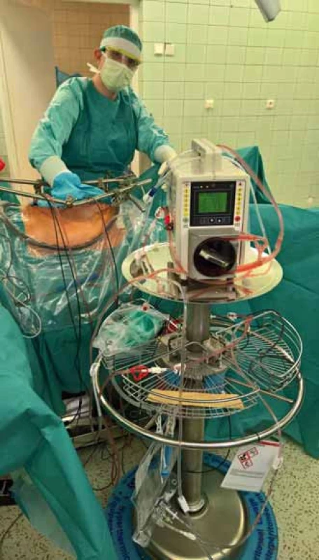 Peritoneální laváž systémem HIPEC.
Fig. 4. Peritoneal lavage with HIPEC system.