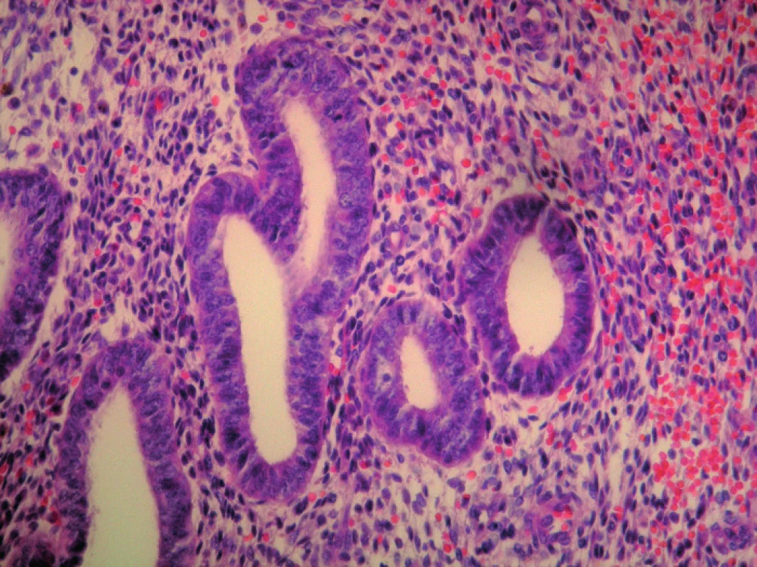 Detailný záber na endometriálne žliazky a endometriálnu strómu s charakteristickým intersticiálnym čerstvým krvácaním, HE 400x
Fig. 4: Endometrial tissue, cells and stroma with characteristic interstitial bleeding, detailed view, HE 400x 