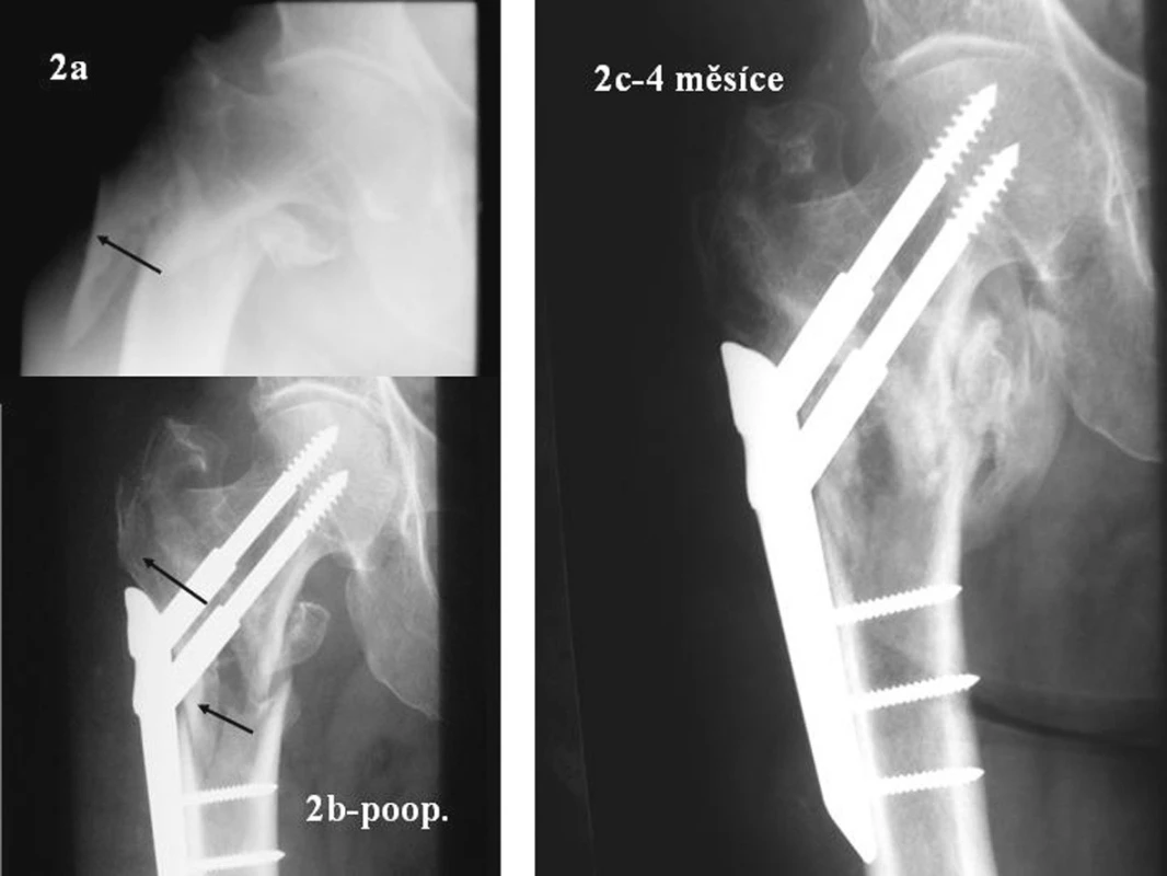 Nestabilní zlomenina 31A3.1 Snímky před a po osteosyntéze PCCP. Dlaha podepřela odlomenou laterální stěnu. Za 4 měsíce zhojeno. Šipky ukazují laterální stěnu před a po osteosyntéze
Fig. 2. Unstable 31A3.1 fracture. Views taken prior to and after PCCPosteosynthesis. The lateral fragment supported by a fixation plate. Healed in 4 months. The lateral fragment prior to and after osteosynthesis, marked with arrows