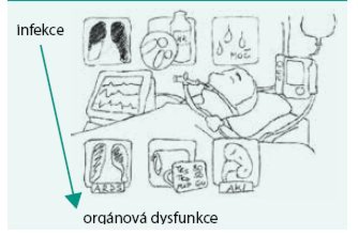 Sepse dle definice SEPSIS-3