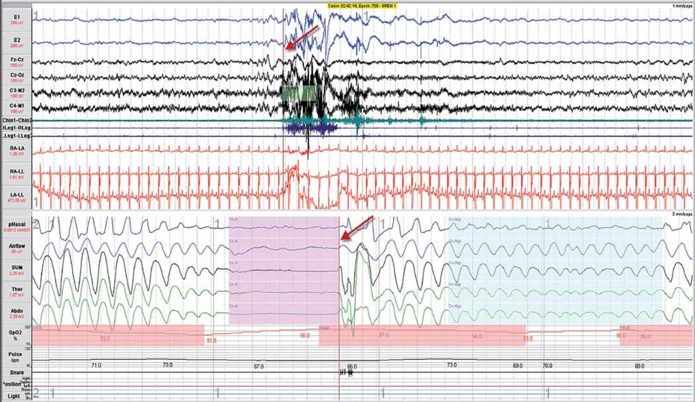Příklad centrální spánkové apnoe (vlevo) a hypopnoe (vpravo). Ze záznamu nejsou patrné paradoxní pohyby břicha (Abdo) a hrudníku (Thor). Šipky ukazují na místo se stejným časem v polysomnografickém záznamu, kdy respirační událost je doprovázena probouzecí reakcí (arousal). Definice jednotlivých snímaných signálů je uvedena v části: Hodnocení polysomnografického záznamu.
