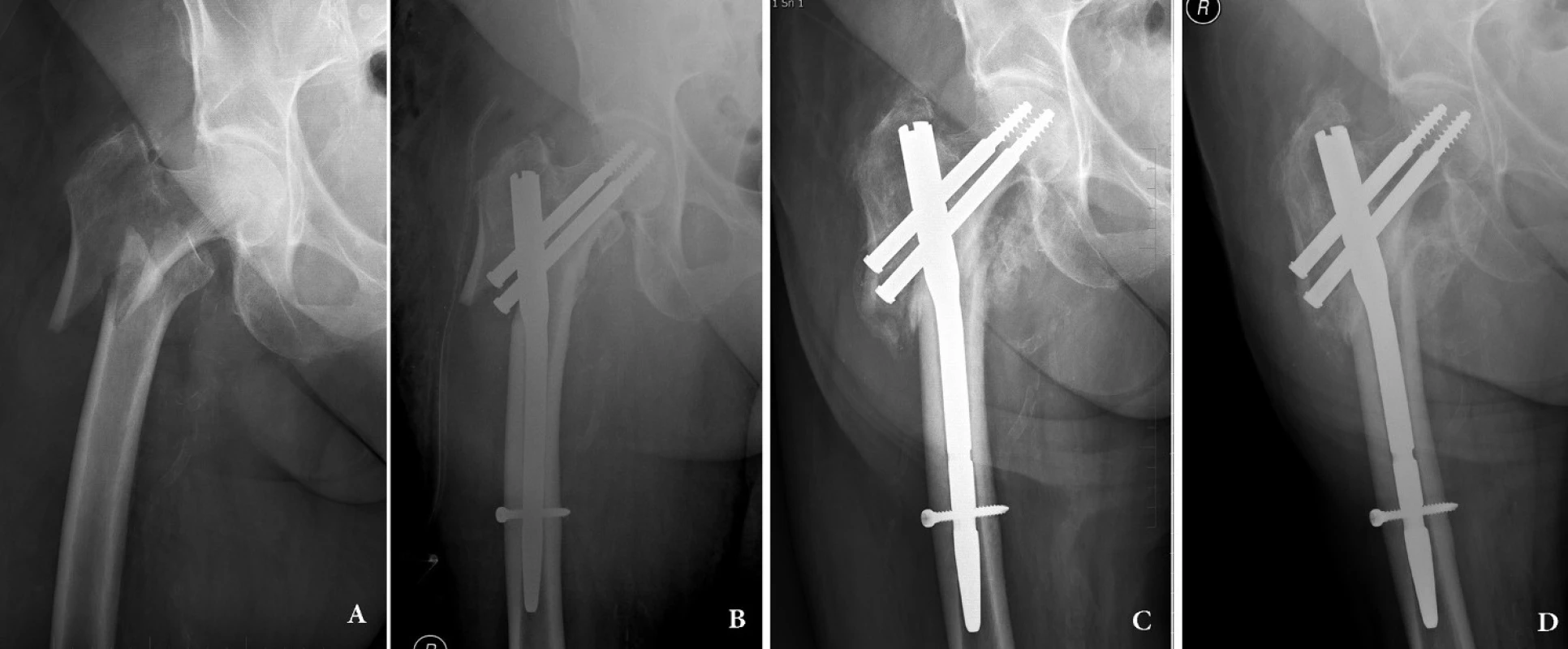 Intertrochanterická zlomenina 31–A3: a – úrazový snímek; b – osteosyntéza krátkým rekonstrukčním hřebem Medin, hřeb je zajištěn dynamicky; c – ve 3 měsících se zlomenina hojí svalkem, je patrné dosednutí fragmentů; d – stav 12 měsíců po operaci, zlomenina je zhojená.
Fig. 1: Intertrochanteric fracture 31 – A3: a – injury x-ray; b – internal fixation by short reconstruction nail Medin with dynamic distal locking; c – compression of the two main fragments along the axis of the nail and callus formation in the fracture line; d – 12 months after surgery, the fracture is healed.