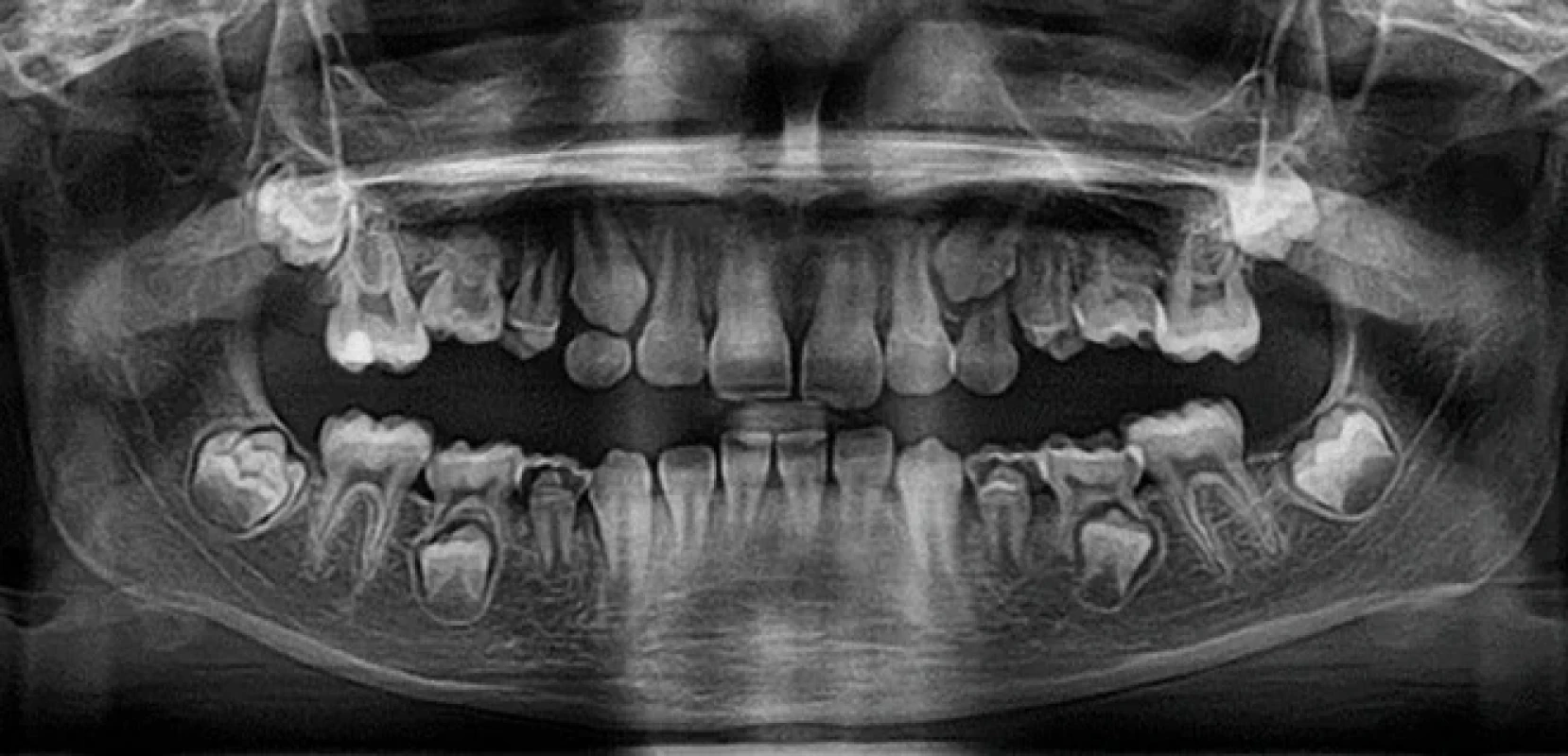 Ortopantomogram ve věku devět let. Zdroj: Dokumentace pacientky. Fig. 3 Orthopantomogram at the age of 9 years. Source: Patient’s medical records.