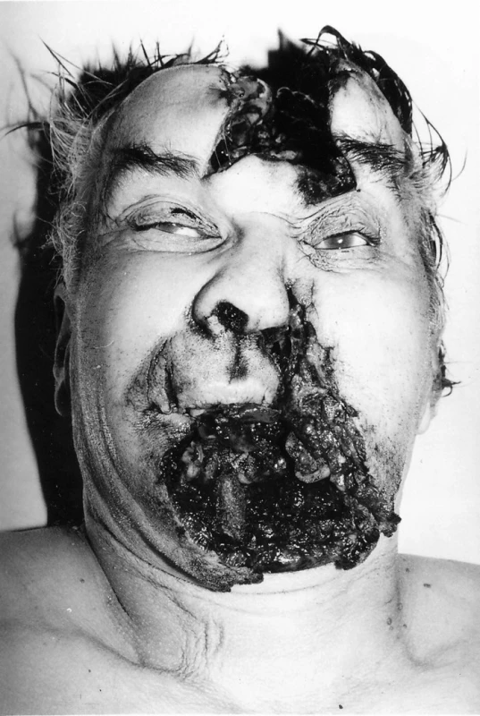 Rozsáhlé mutilující poranění hlavy s místem vstřelu pod bradou. Sebevražda jednotnou střelou typu S-BALL (Sellier&amp;Bellot<sup>©</sup>) při střelbě z absolutní blízkosti
