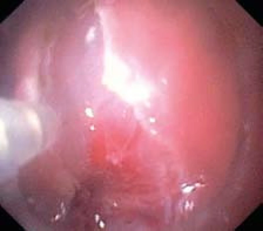 Submukózní disekce pomocí nástroje flush-knife.
Fig. 4. Submucosal dissection with aid of flush-knife.