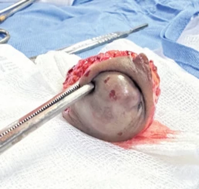 Resekát umbilikální metastázy. Fig. 3. Umbilical metastasis tissue.