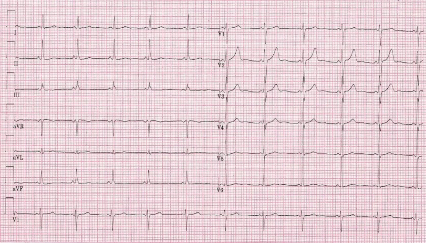 EKG: krátký interval PQ (98 ms) – 40letá pacientka s Fabryho chorobou (zdroj: II. interní klinika – klinika kardiologie a angiologie 1. LF UK a VFN v Praze)