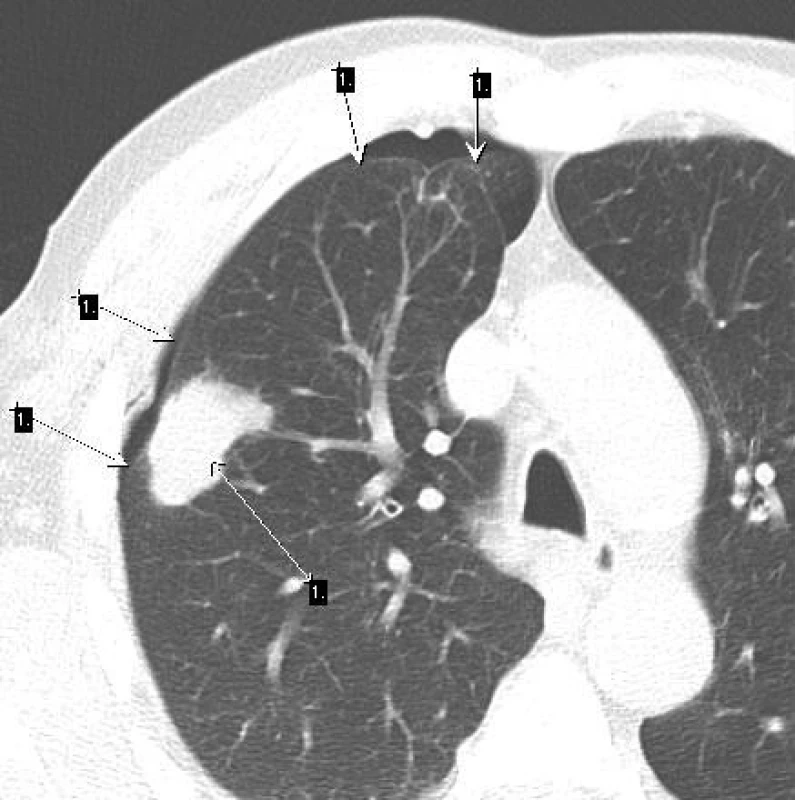 Pomalu rostoucí ložisko (šipka 1)
Po biopsii vznikl pneumothorax (šipky 2). Revmatoidní uzel.