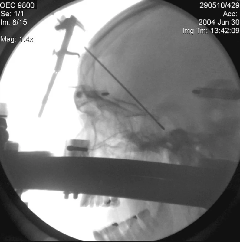  Intraoperační kontrola polohy elektrody
Fig. 4. Intraoperative control of an electrode positioning
