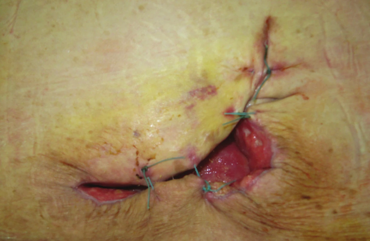 Dvacátý pooperační den – ambulantní převaz
Fig. 6. Postoperative Day 20 – ambulatory change of the bandage