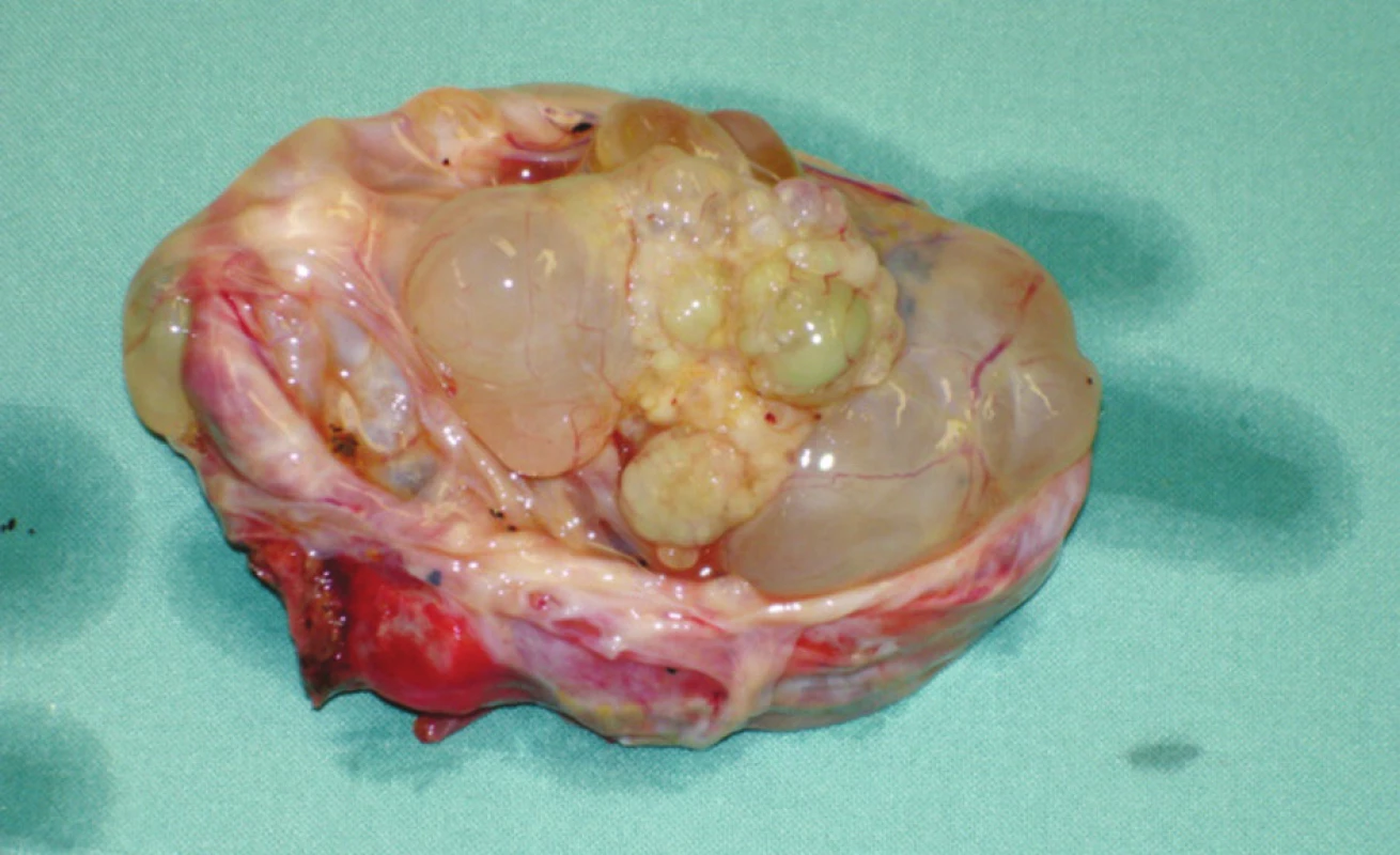 Cystadenom jater – preparát – případ 2 
Photo 1. Liver cystadenoma – a preparation – case No. 2