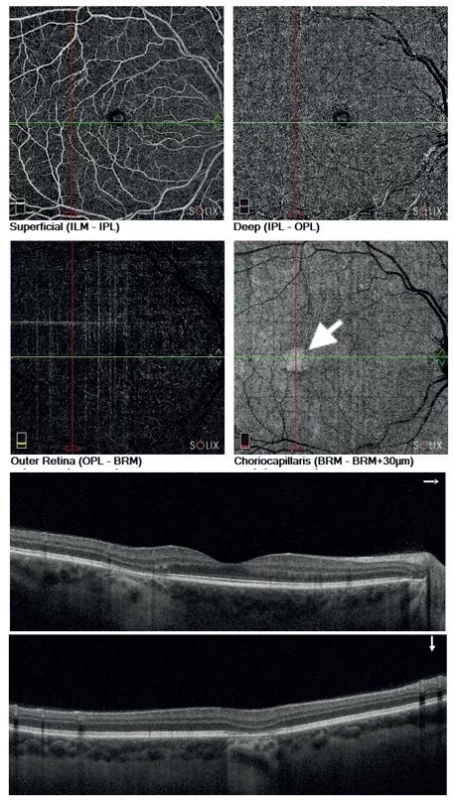 OCT angiography of the right eye – the superficial and deep capillary plexus with normal vascularity and the choriocapillaris with an increased signal due to atrophy of RPE (white arrow)