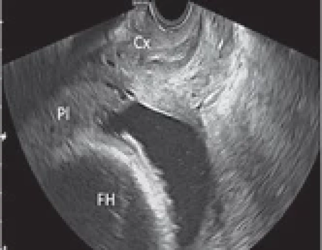 Transvaginal ultrasound performed at 38.5 weeks’ gestation detecting a placenta previa, partial type. Cx – cervix, FH – fetal head, Pl – placenta.
