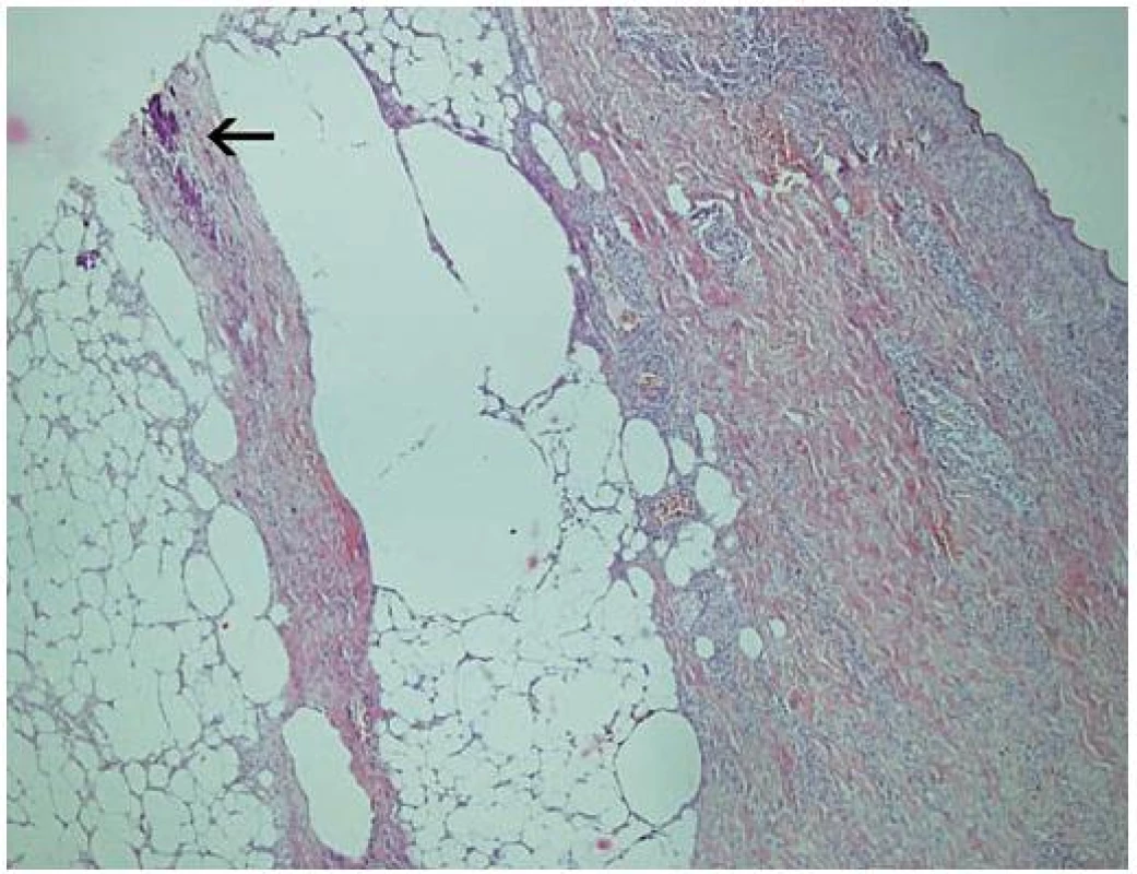 Histologický nález
Šipkou označeno bazofilní ložisko v septu subcutis odpovídající výrazné kalcifylaxi kolagenního vaziva, v přilehlémlobulu subcutis jsou lipofágy, v koriu jsou patrné extravazáty erytrocytů a zánětlivé infiltráty (zvětšení 40krát, barvení HE).