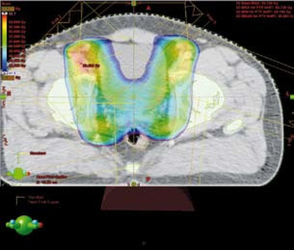 Šetření části rekta při použití techniky IMRT – barevně znázorněna 95% izodóza
Fig. 3. IMRT technique – sparing of posterioir rectal wall (95% isodoses in colors)