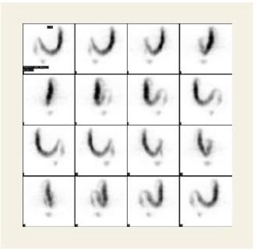 Jednofotonová emisní tomografie (SPECT) – distribuce 67Ga-citrátu v tlustém střevě.
Fig. 3. Single photon emission tomography (SPECT) – 67Ga-citrate distribution in the colon.